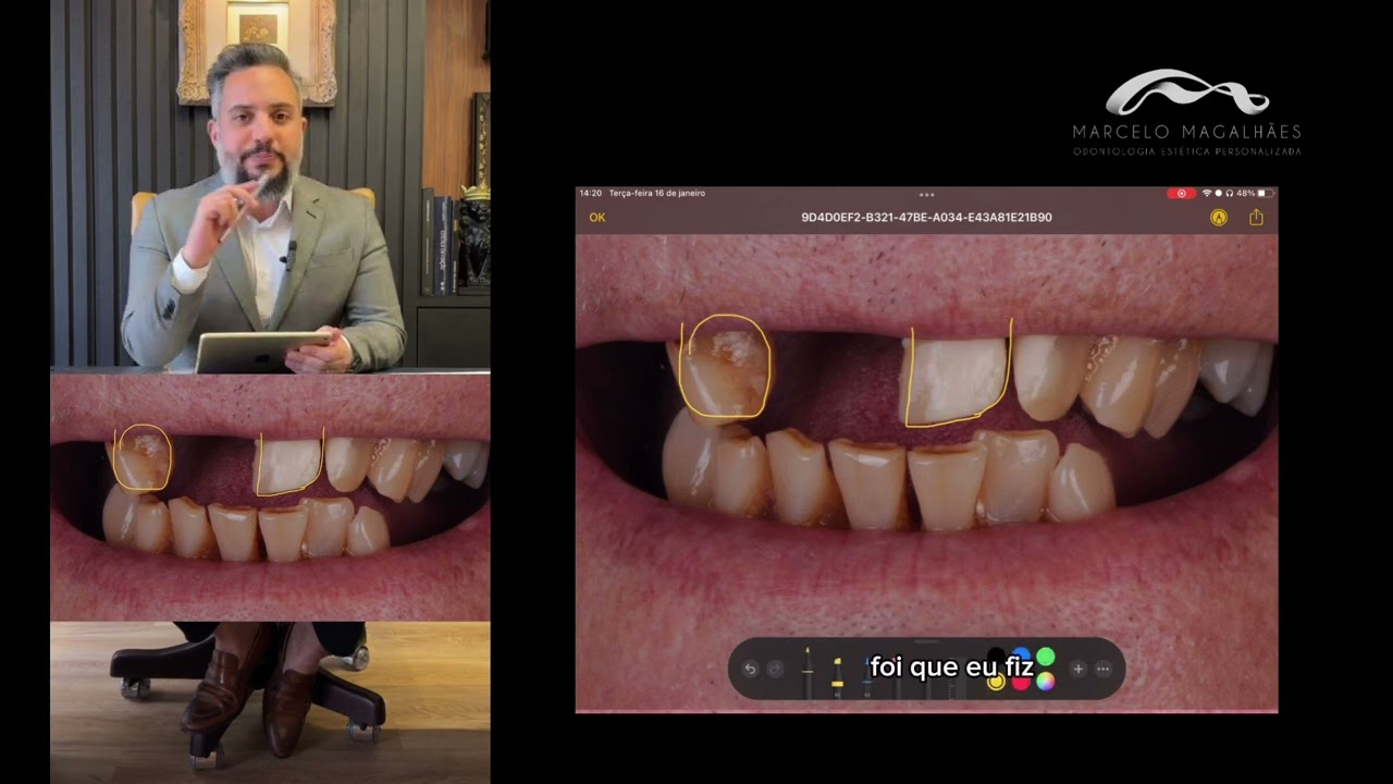 Implantes dent&aacute;rio sem dor: an&aacute;lise de caso complexo