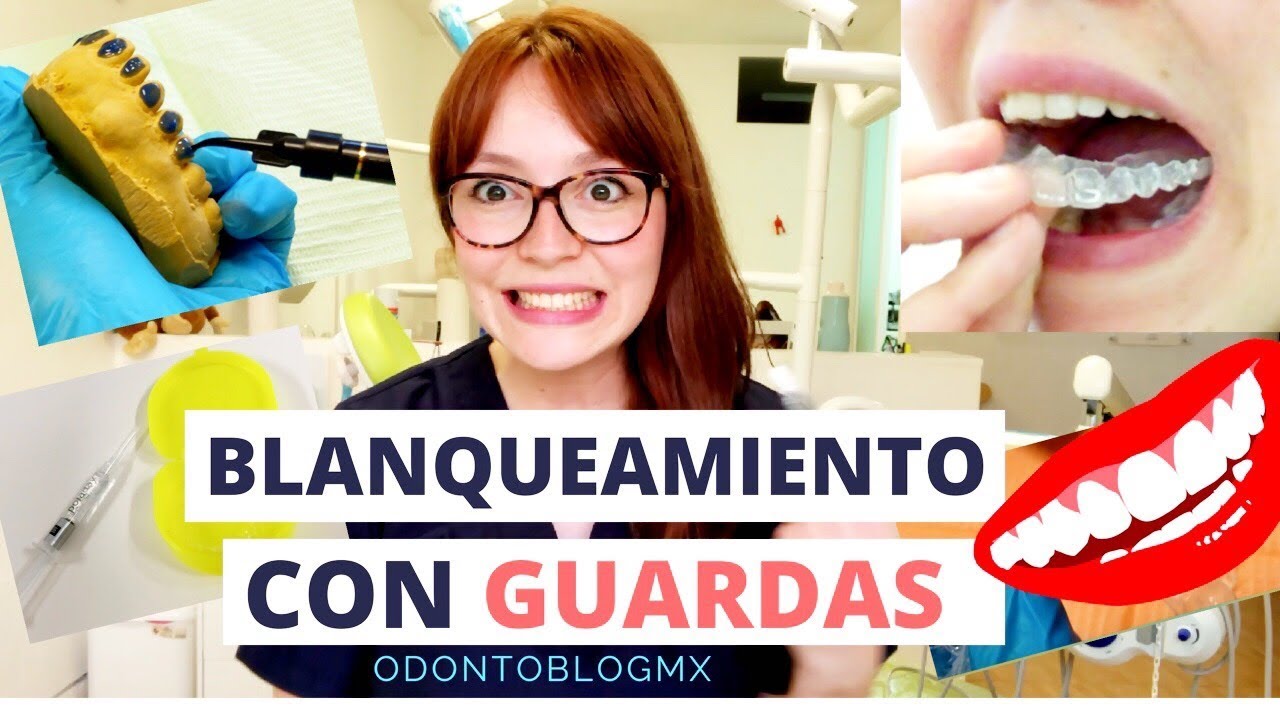 ¡¡Me hice un Blanqueamiento Dental con Guardas!! // Explicación paso a paso