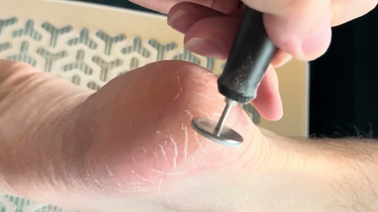 How to remove thick, hard callused skin with an e-file