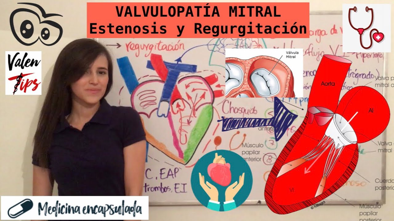 VALVULOPATÍA MITRAL TIPO ESTENOSIS Y REGURGITACIÓN♥️ La más común de las cardiopatía valvulares‼️
