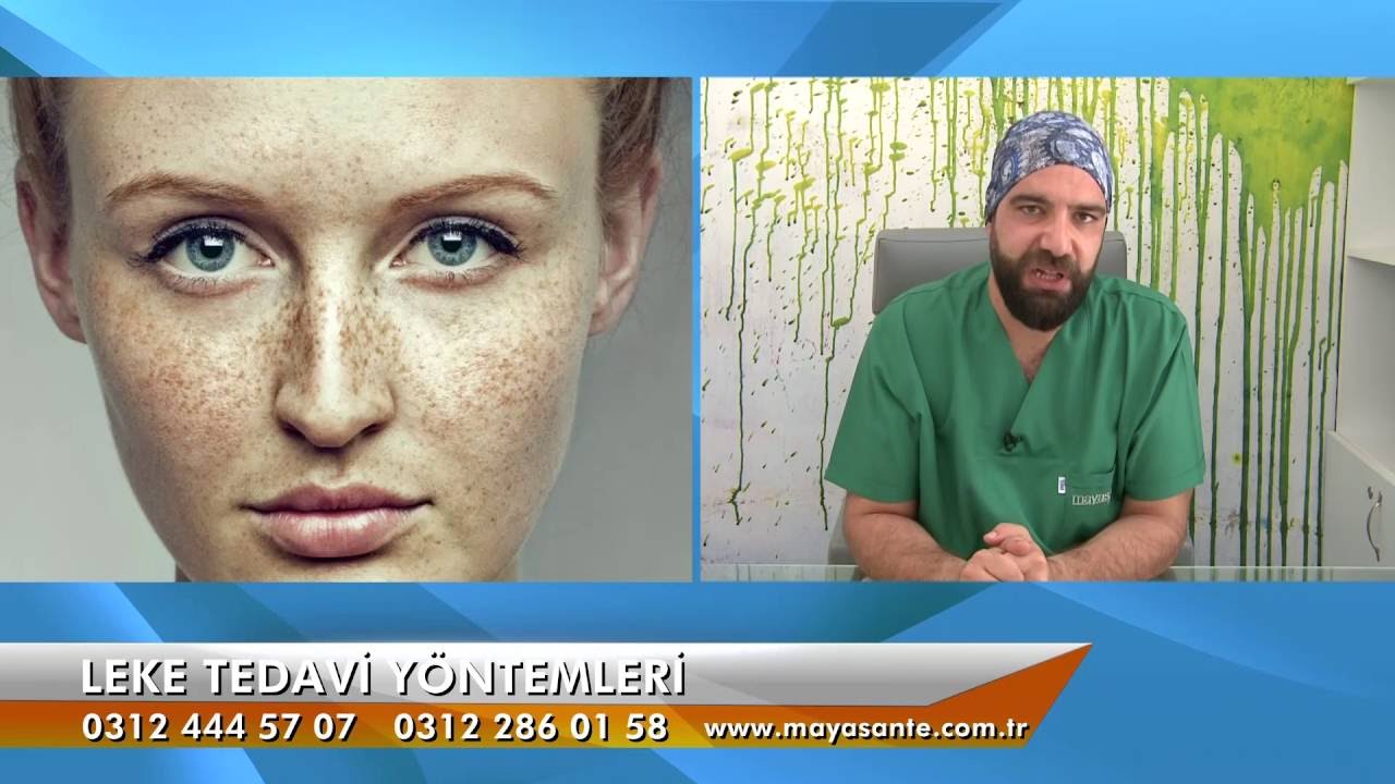 Leke Tedavi Y&ouml;ntemleri (Thulium Lazer)