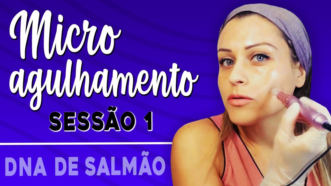 MICROAGULHAMENTO COM DERMAPEN - DNA de Salmão - Remover Manchas, Afinar os Poros- Tratar Rugas