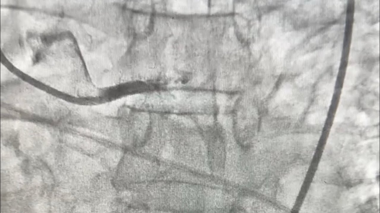 Обширный инфаркт миокарда с подъемом сегмента ST. 100% окклюзия левой главной коронарной артерии/...