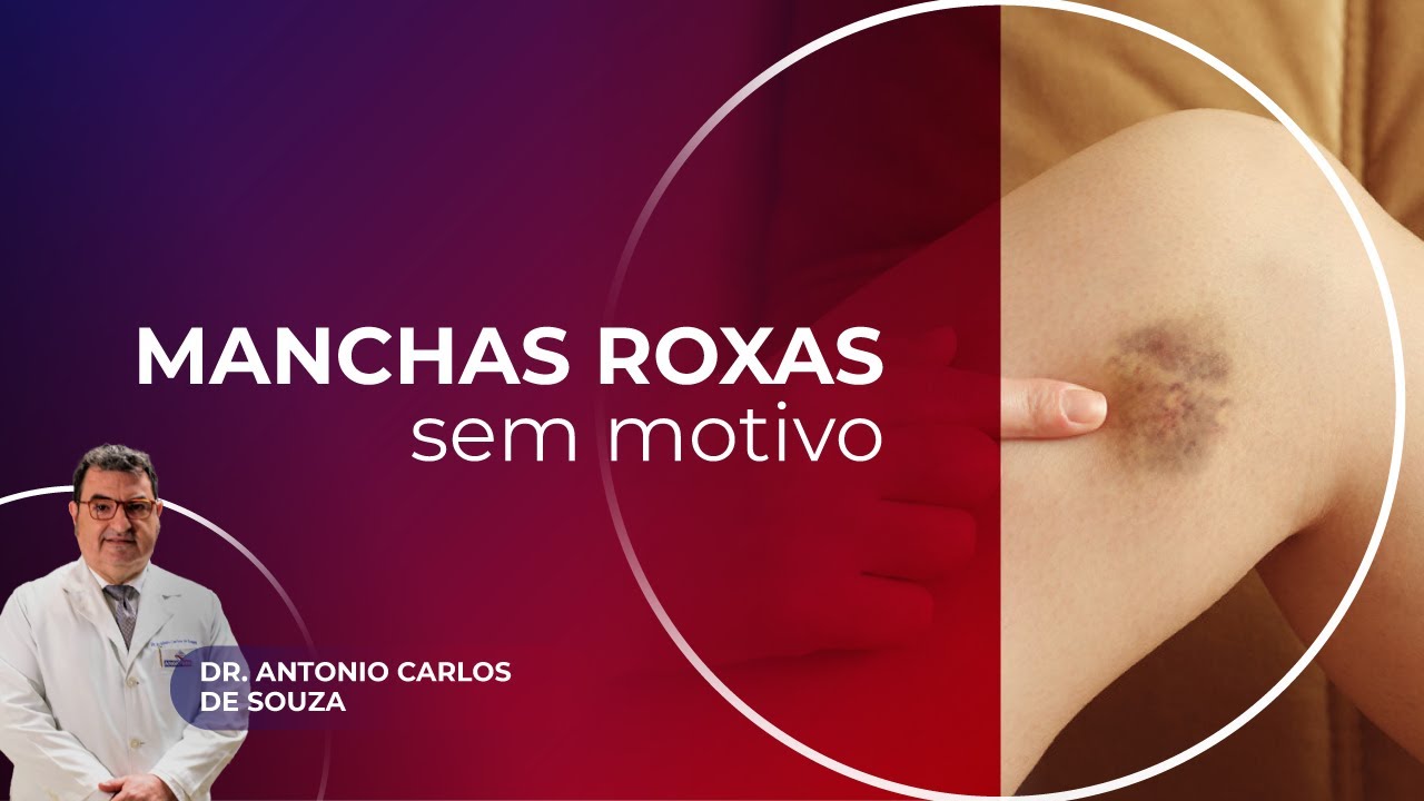 MANCHAS ROXAS SEM MOTIVO | Dr. Antonio Carlos de Souza