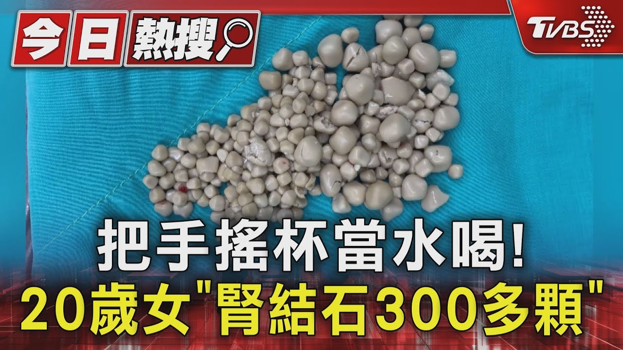 把手搖杯當水喝! 20歲女「腎結石300多顆」｜TVBS新聞 @TVBSNEWS01