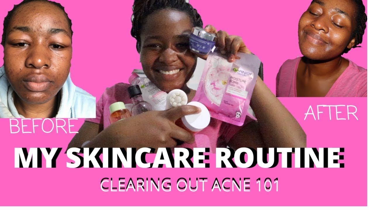 Skincare Routine | After the Duac Gel experience | Skincare