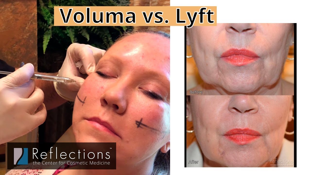 Voluma vs. Restylane Lyft [Filler Options Compared for Cheeks, Chin, Nose, Temples, & More!]
