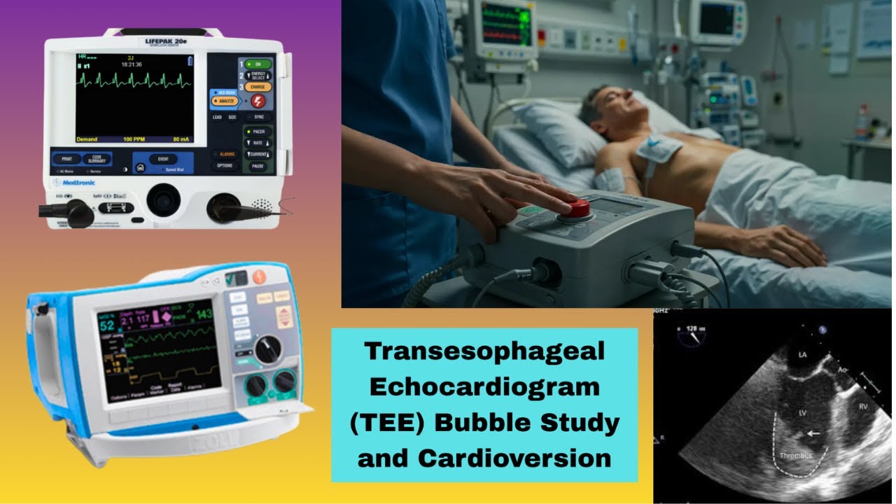 Transesophageal Echo & Cardioversion for Atrial Fibrillation