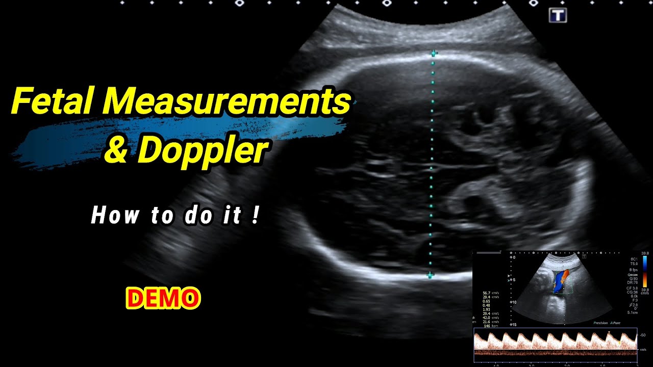 Fetal measurements and Doppler | How to do it !