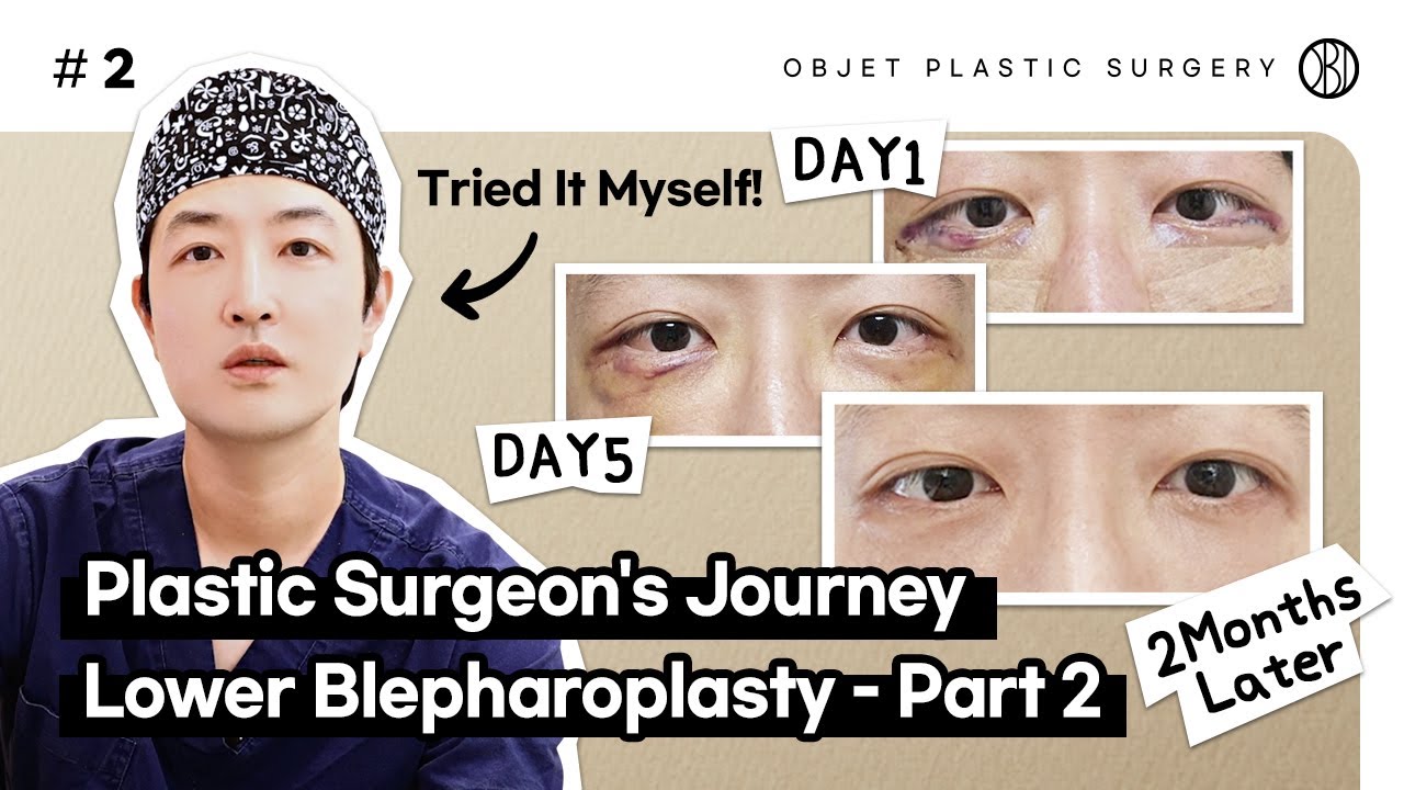 Plastic Surgeon's Lower Blepharoplasty Journey | Recovery, Symptoms & Expert Insights