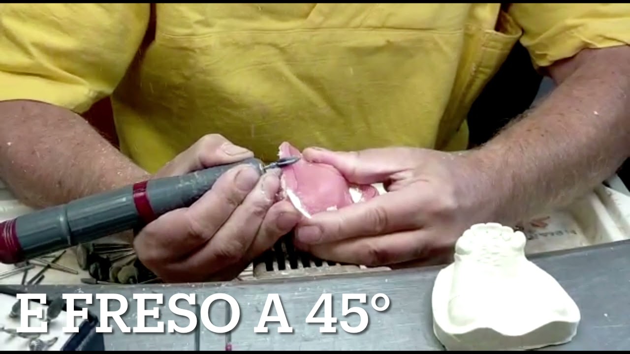 Resinatura e rifinitura di un parziale con ganci (tutorial scolastico)