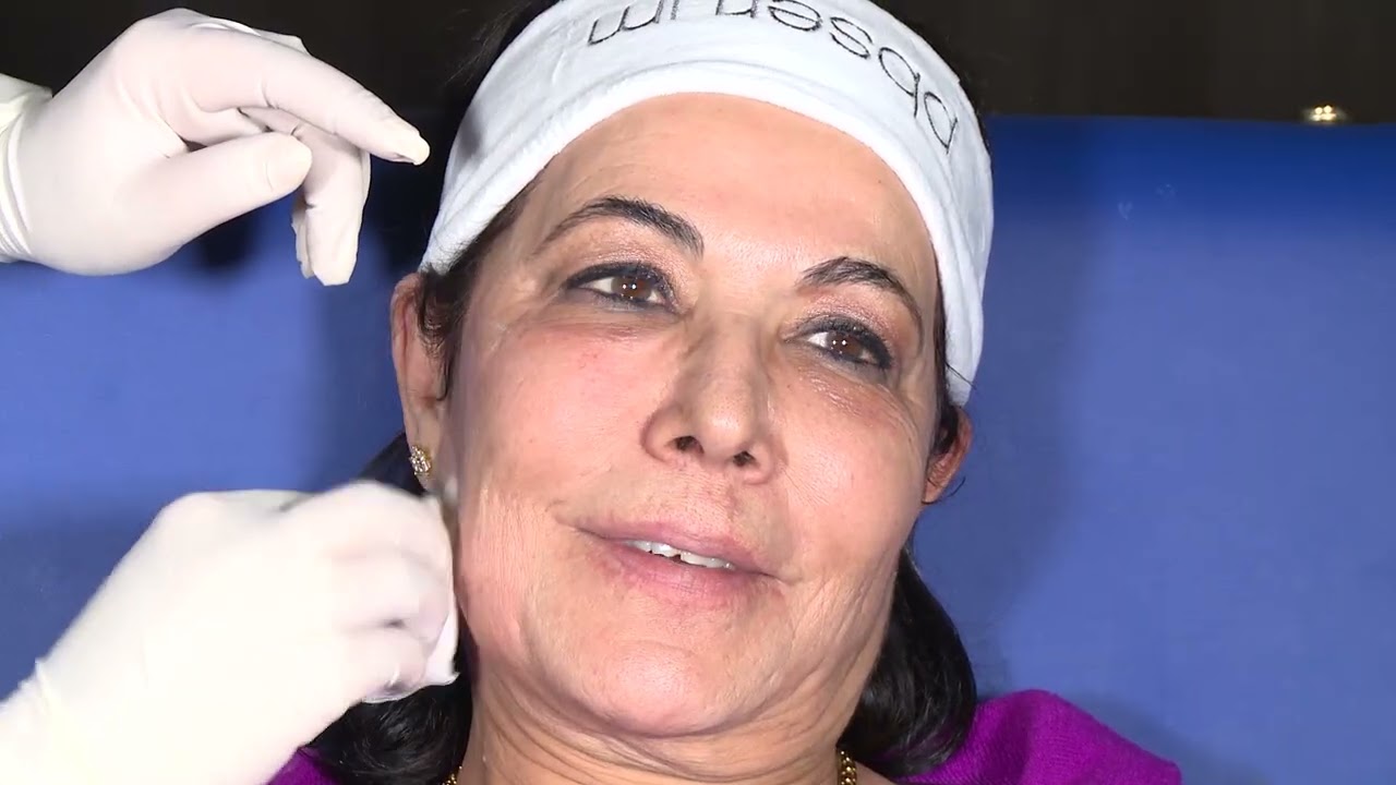 LIVE DEMO - Nouvelle génération de fillers Nexha by mesoestetic - Dr El Allam Hanadi Houda