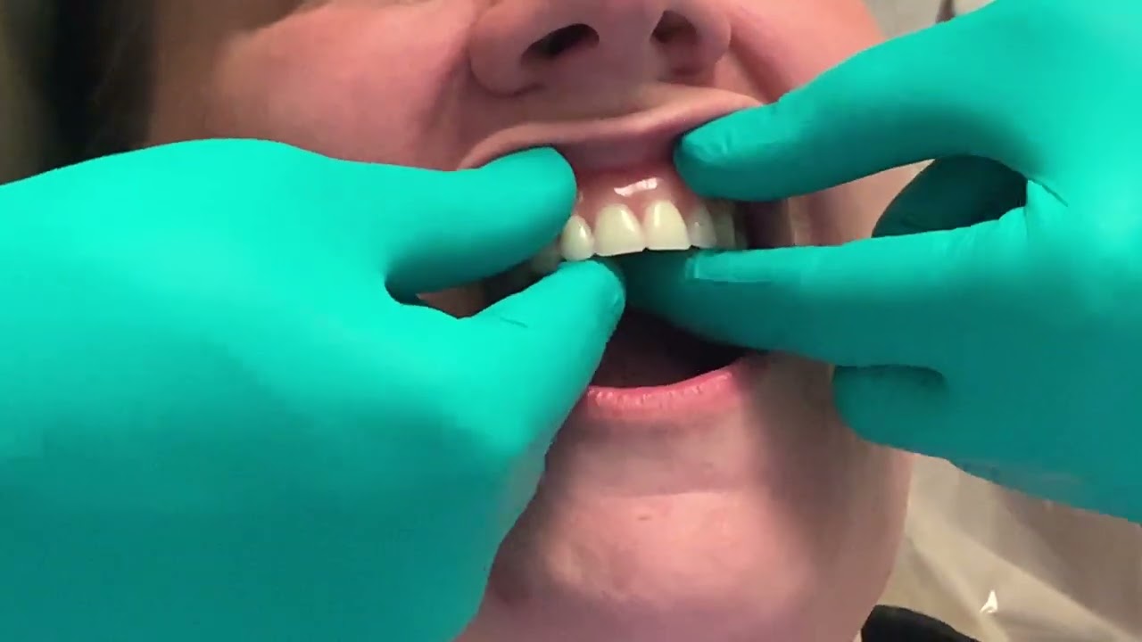 strong retention of Implant supported removable denture