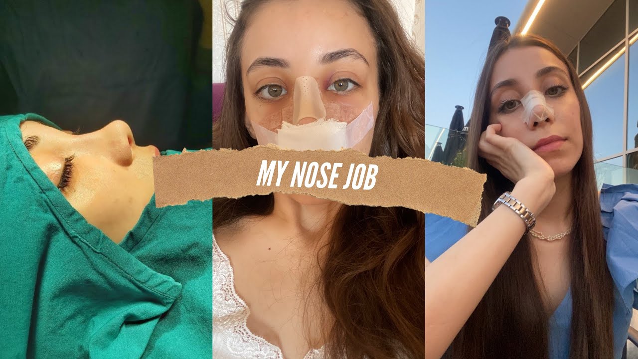 Burun Əməliyyatım || Rinoplastika || Rhinoplasty
