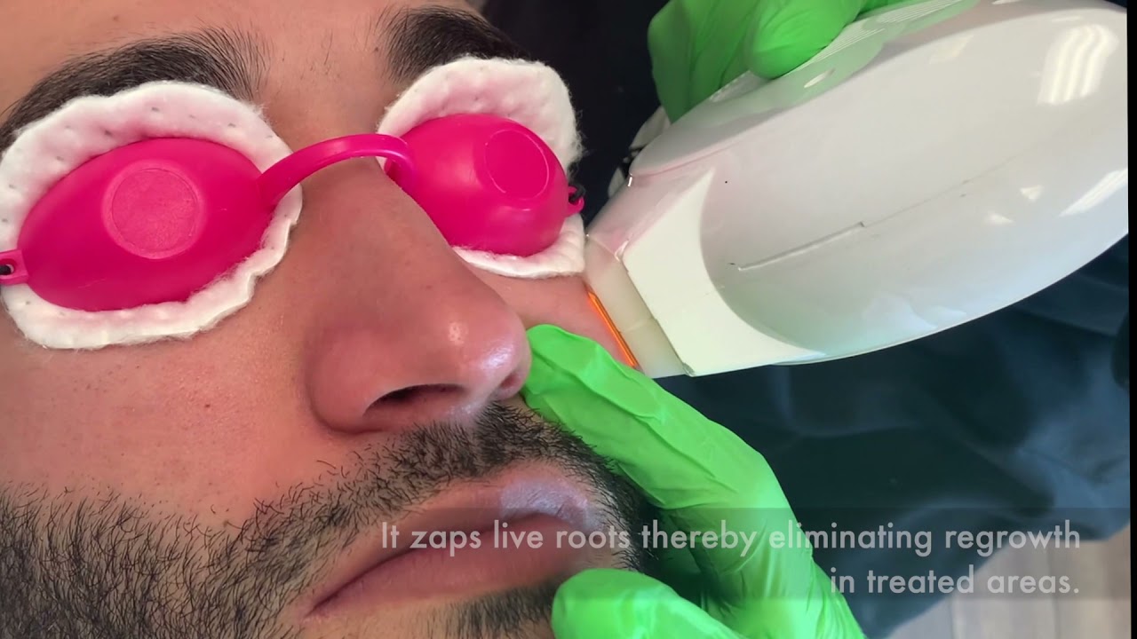 IPL Hair Removal Beard Line