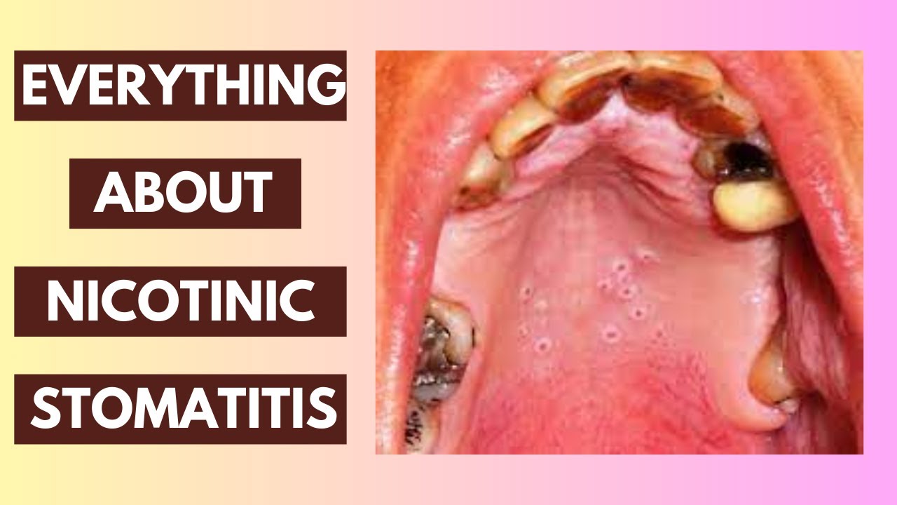 Nicotinic Stomatitis Explained: Causes, Symptoms, and Treatment Options | In-Depth Lecture