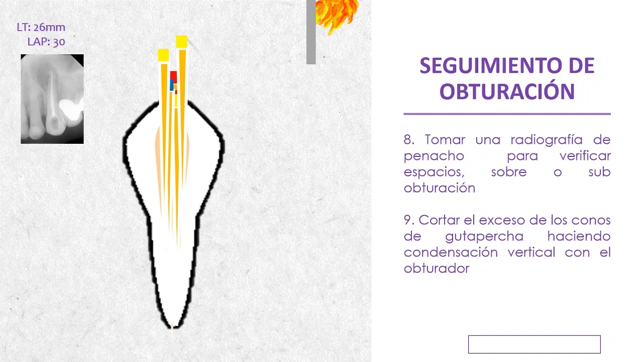 Técnica de condensación Lateral