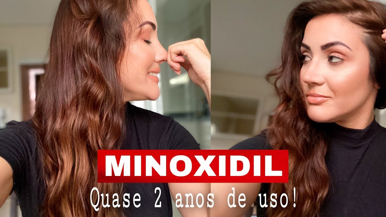 MINOXIDIL: Meu cabelo vai CAIR se eu parar de usar? RESPONDI tudo após quase 2 anos de uso!