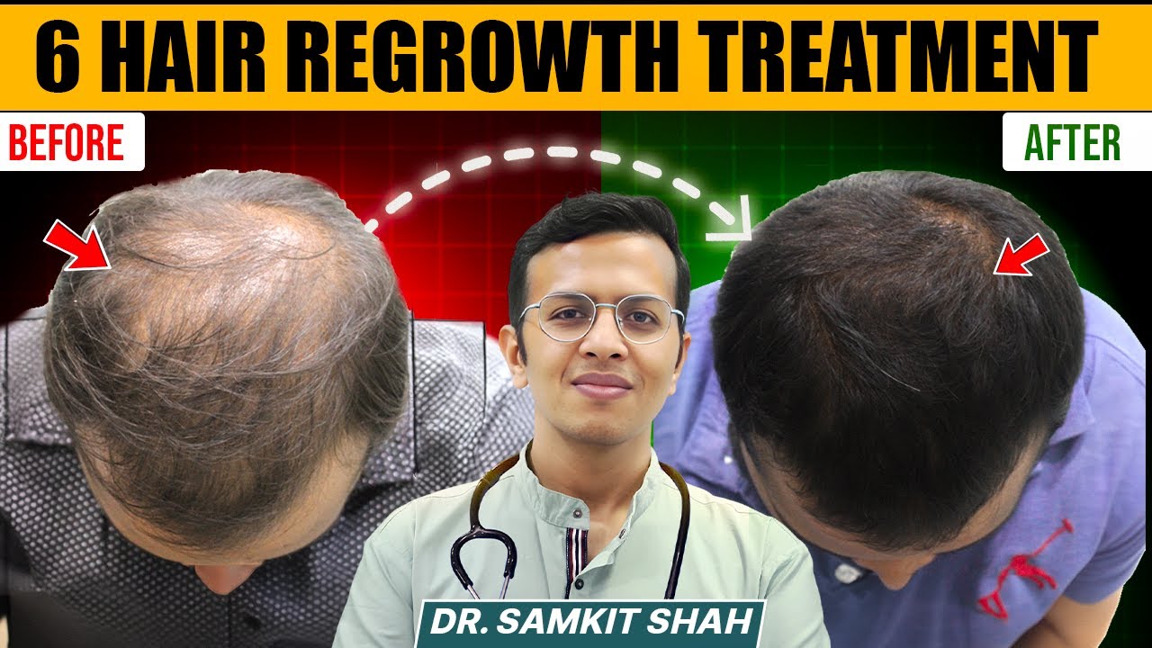 Hair Fall ke Liye Kaun sa Treatment Kare? 6 Best Hair Regrowth Treatment By Dermatologist