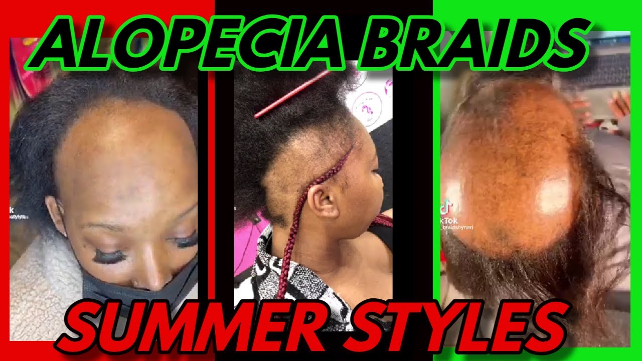 ALOPECIA BRAID STYLES FOR THE SUMMER