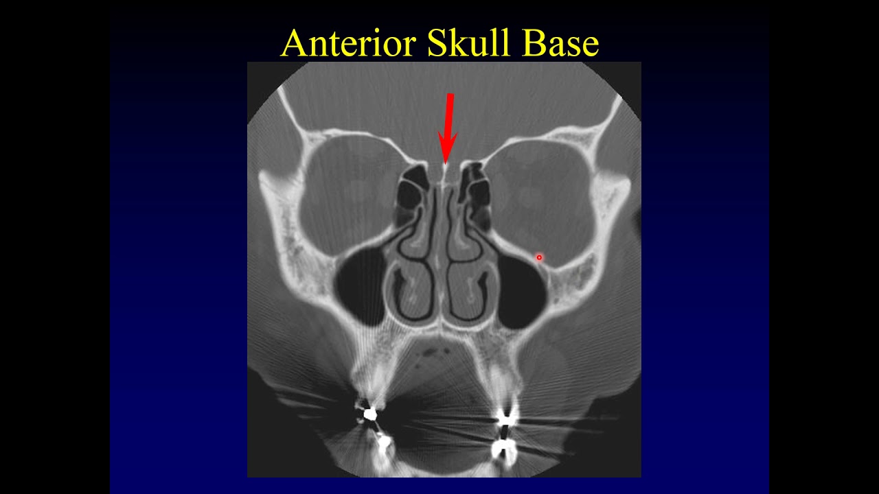 Imaging of the Paranasal Sinuses 1