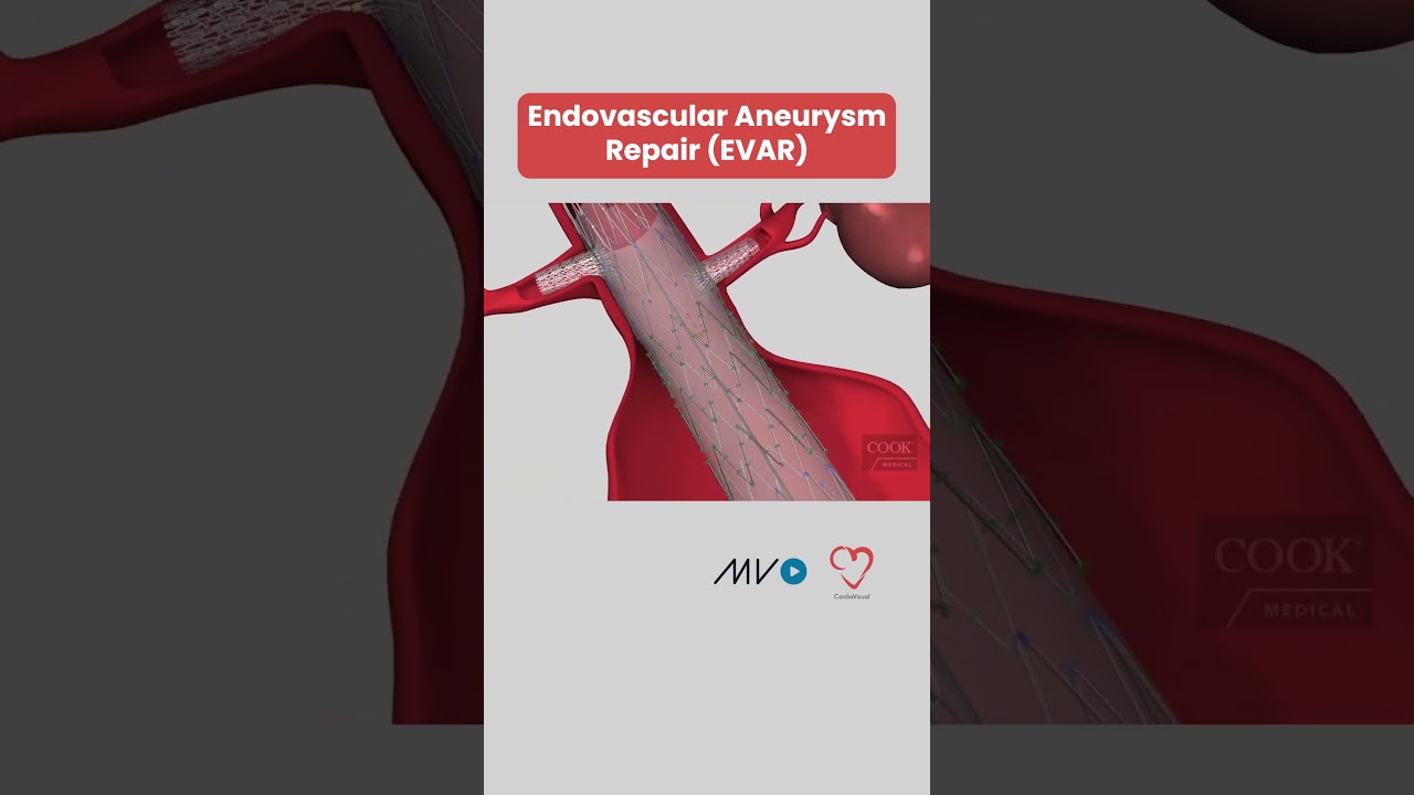 Endovascular Aneurysm Repair 🫀🛠️