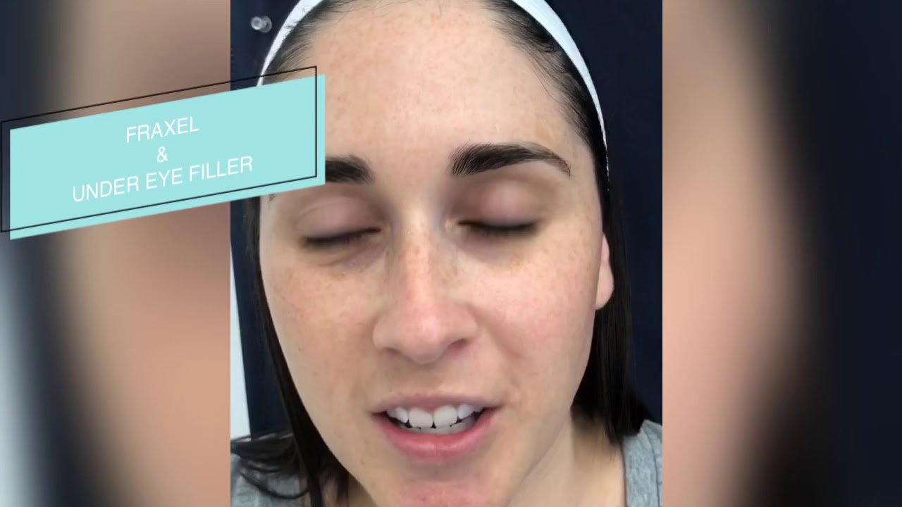 Fraxel & Undereye Rejuvenation