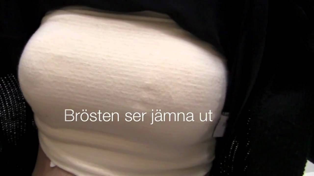 Br&ouml;stf&ouml;rstoring 365 g med br&ouml;stlyft efter 4 timmar p&aring; Nackakliniken Dr Gustav Aniansson