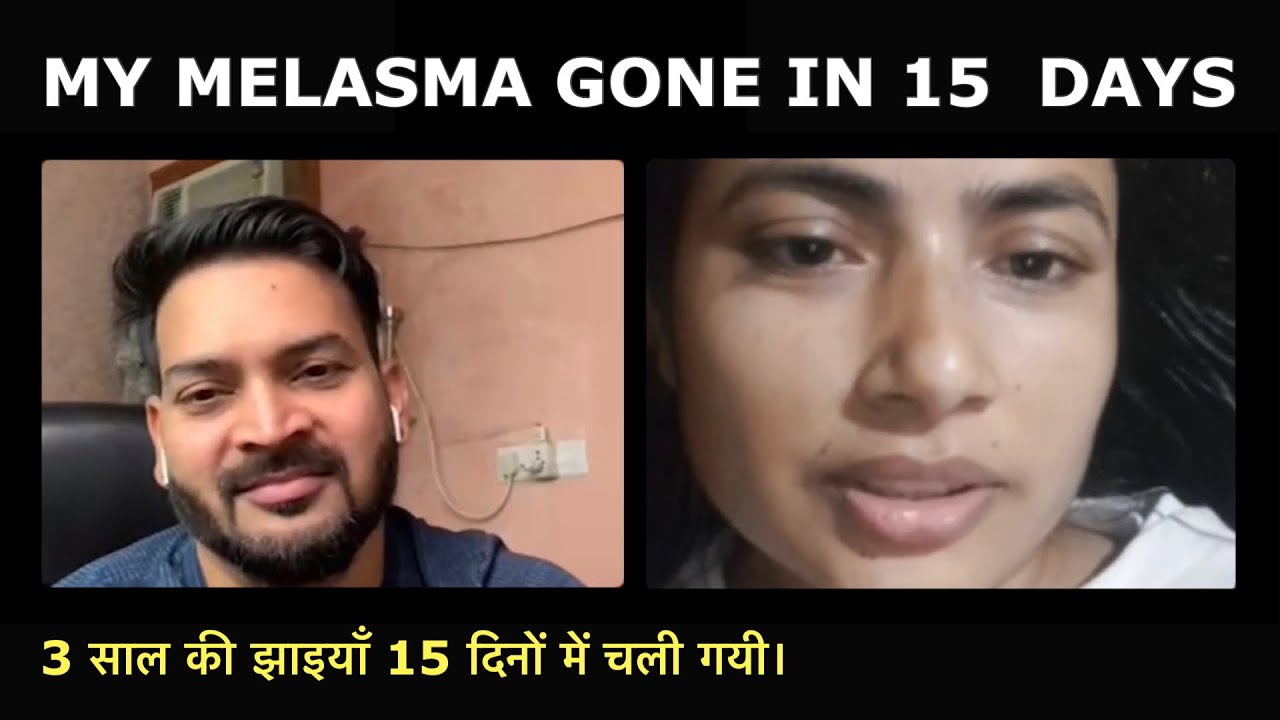 Within 15 days my Melasma/Pigmentation (झाइयाँ) was gone. # HealthySyrusDiet