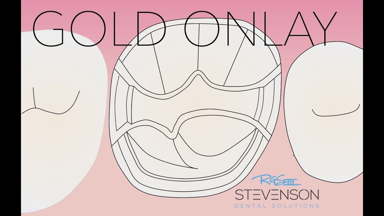 Подготовка MOD Gold Onlay на Typodont #3 Kilgore