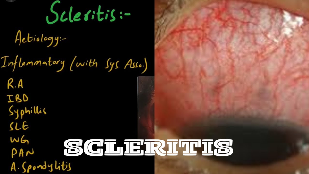 SCLERITIS | Diference between Scleritis and Episcleritis | Part 2