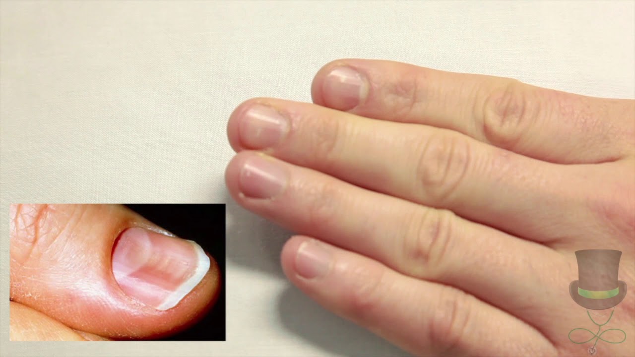 Assessing for Signs of Anaemia