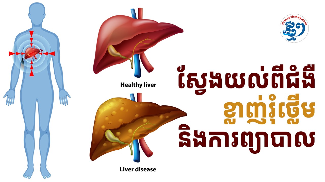 ស្វែងយល់ពីជំងឺខ្លាញ់រុំថ្លើម និងការព្យាបាល