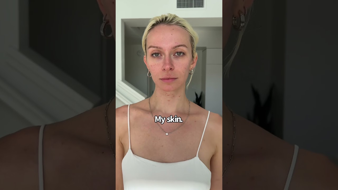 Acne isn&rsquo;t fun&hellip; but it&rsquo;s normal, and it does NOT dictate our beauty🤍 #acne #models #bodypositivity