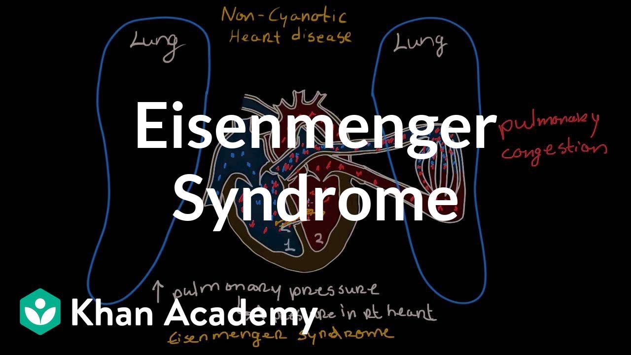 What is Eisenmenger syndrome? | Circulatory System and Disease | NCLEX-RN | Khan Academy