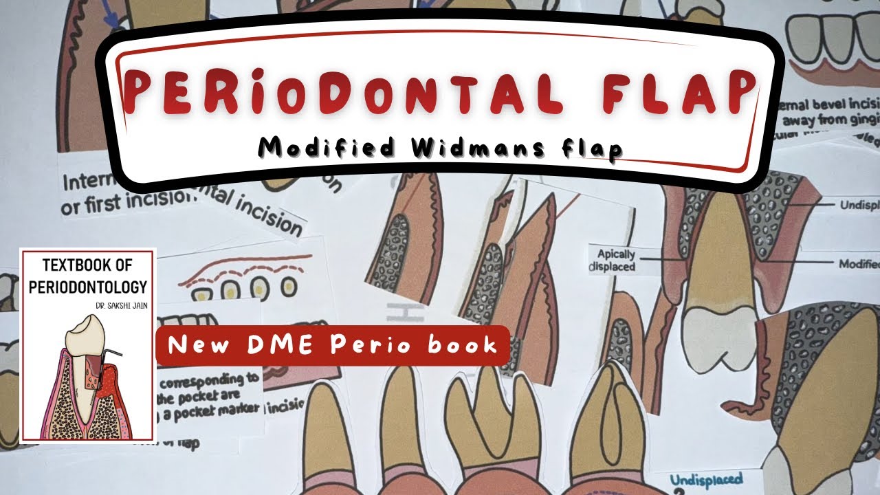 PERIODONTAL FLAP || MODIFIED WIDMANS FLAP || PERIODONTOLOGY 