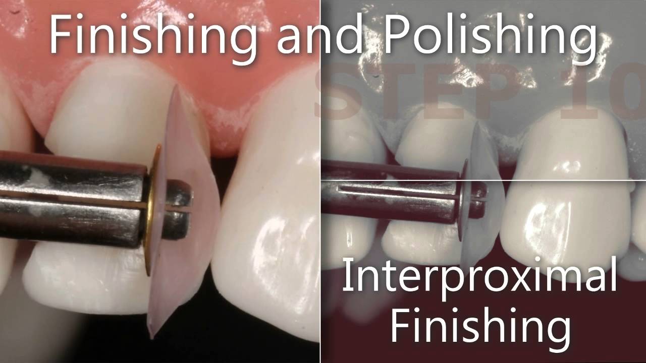 Black Triangle Closure with composite