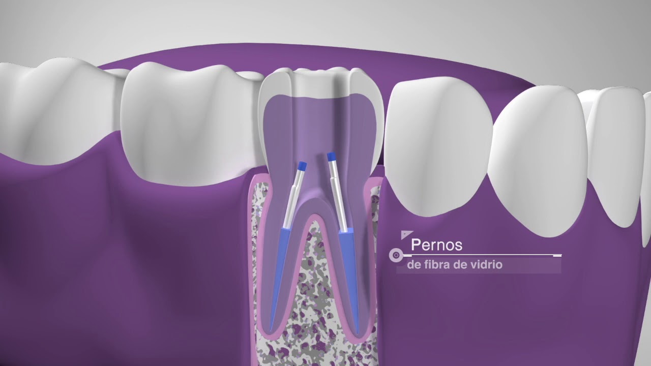 Endodoncia, qu&eacute; es y c&oacute;mo se realiza. DENTIX