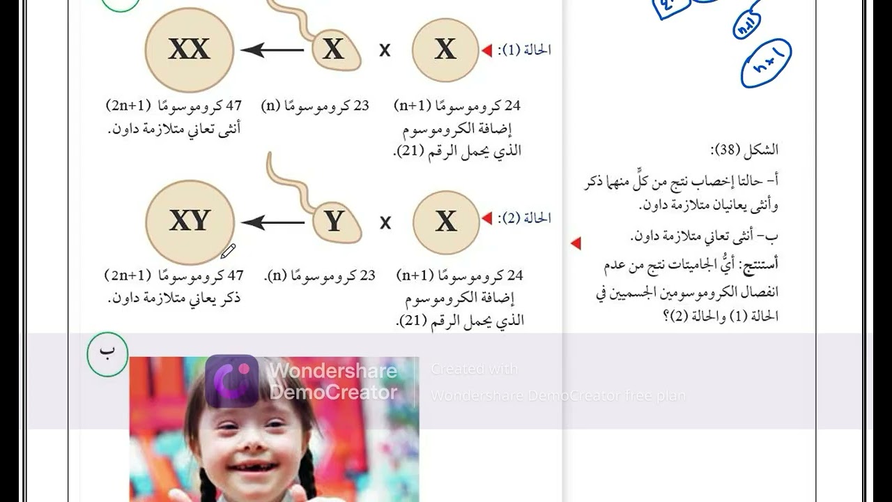 اختلالات ناتجة من الطفرات الجينية و الكروموسومية