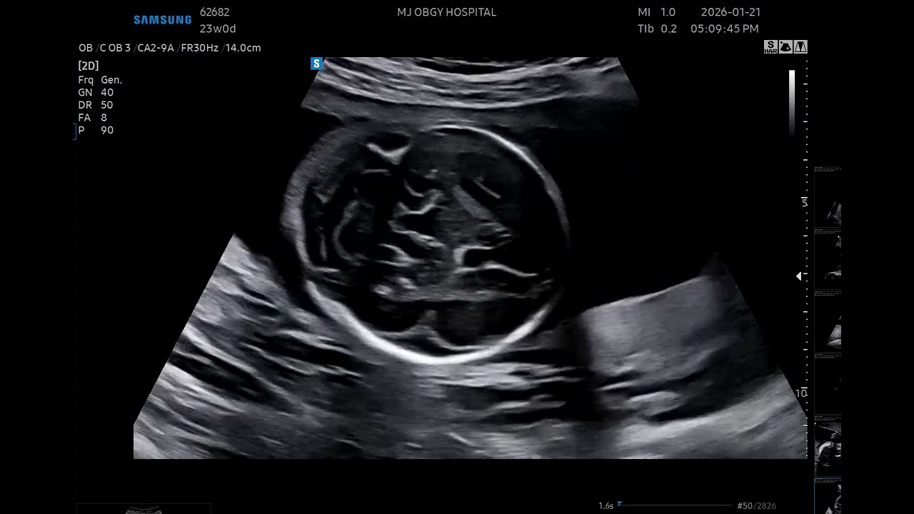 2026.01.21 땡글이 초음파 17