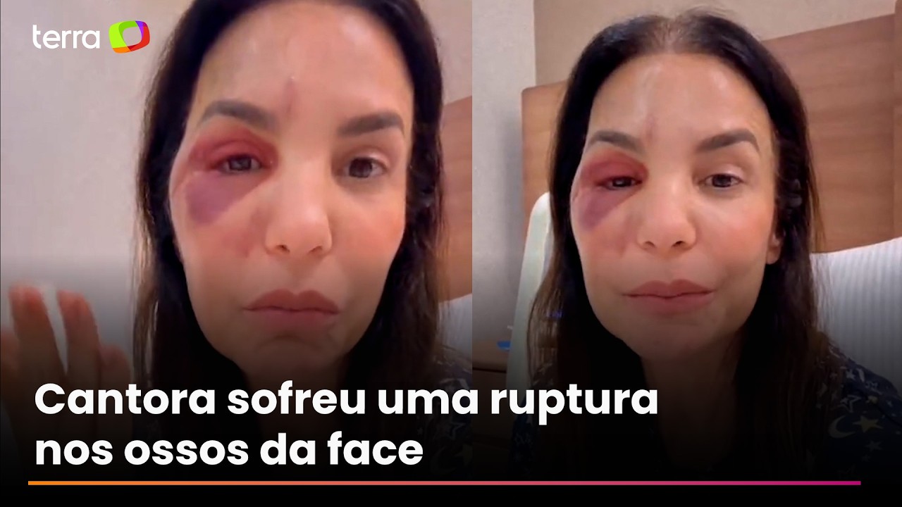 'Houve uma ruptura de osso', diz Ivete Sangalo sobre cirurgia após queda no banheiro