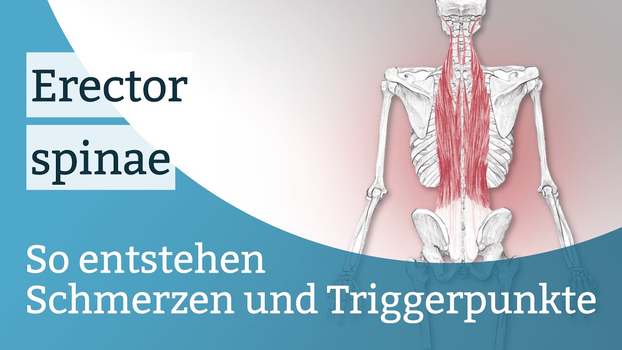 Erector spinae Schmerzen, Triggerpunkte und deren Aktivierung