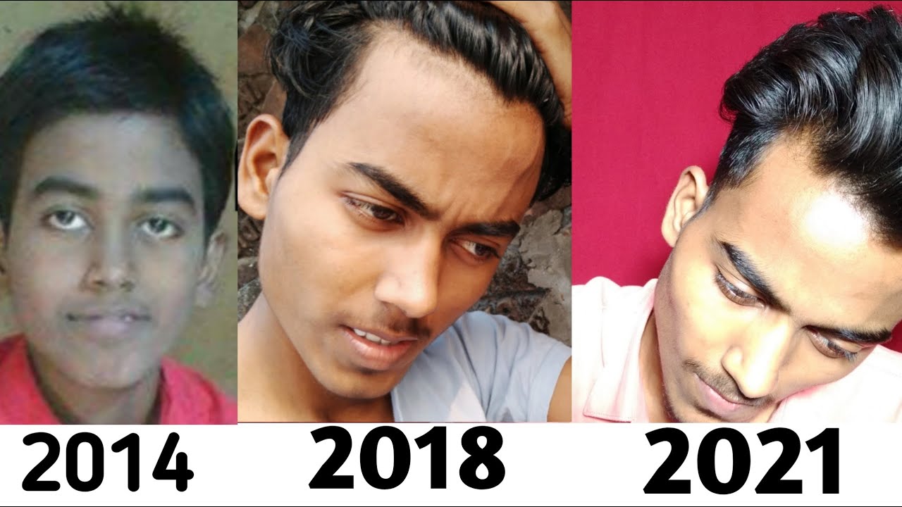 Big Forehead को Receding Hairline समझना Band Karo 😡 🤒| Teenage Receding Hairline Confusion Solved