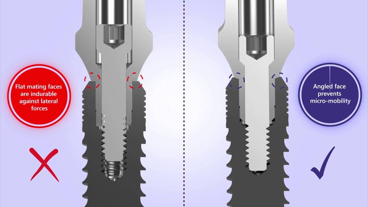 NucleOSS T6 Implant