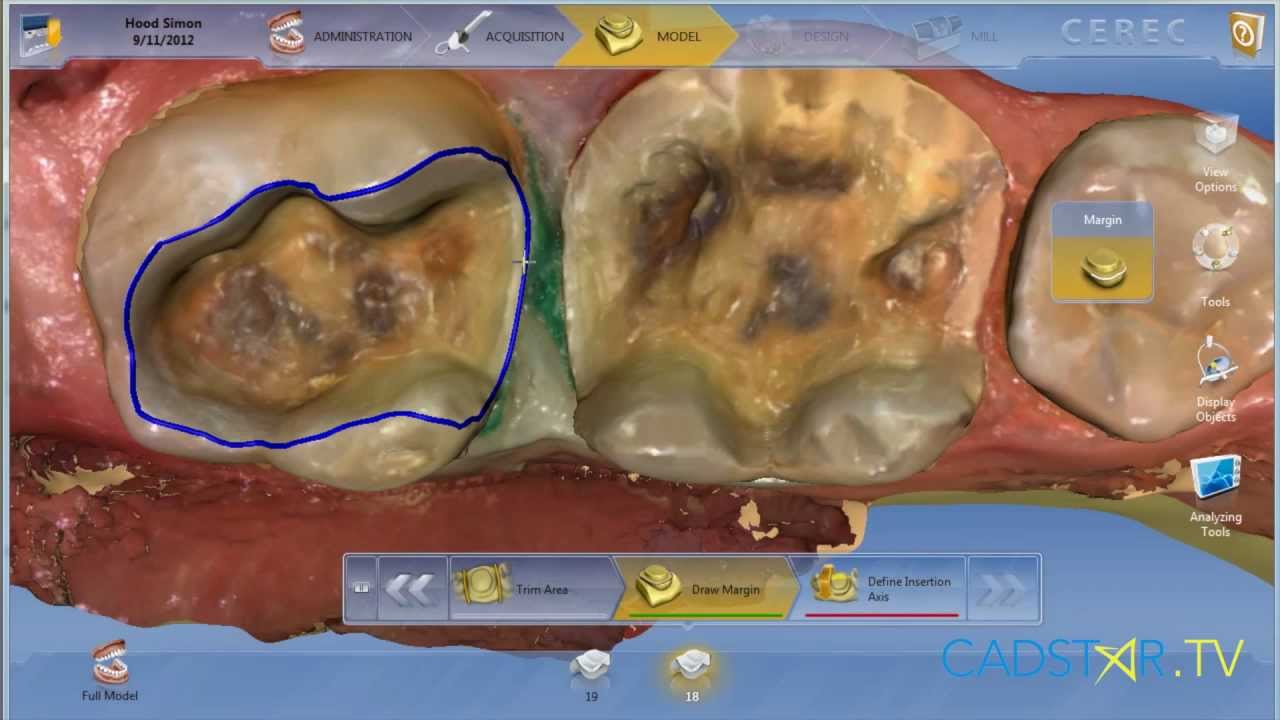 CEREC Omnicam ColorStreaming Quadrant Technique
