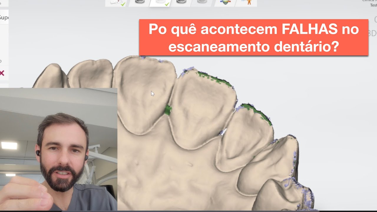 Como escanear com o 3shape trios 3. Por quê acontecem falhas?