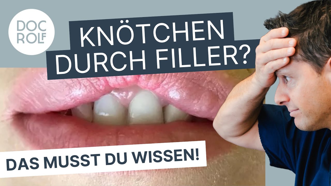 KNOTENBILDUNG nach HYALURON FILLER – das musst du wissen!! doc.rolf
