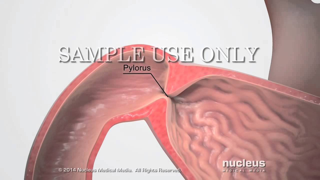 Pyloric Stenosis Blocked Stomach