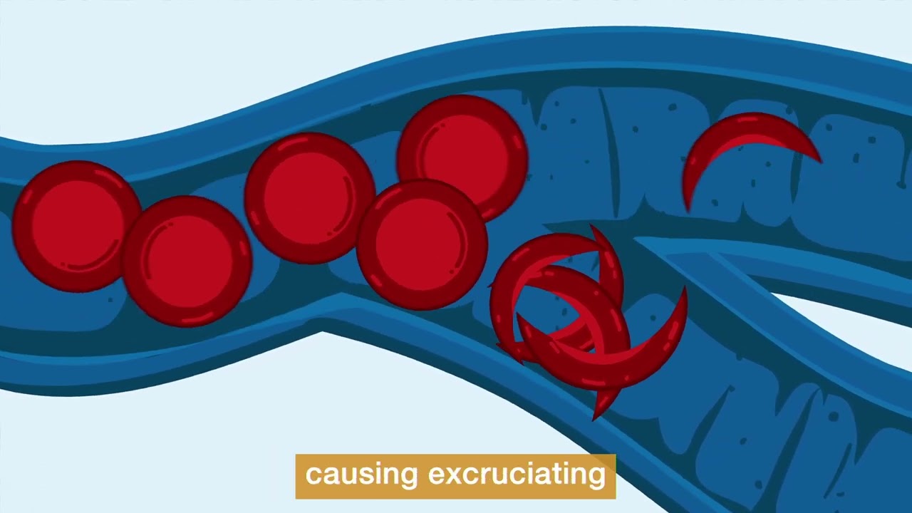 Sickle Cell Disease: What You Need to Know