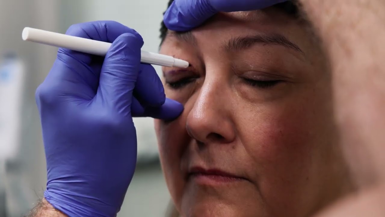 Why Patients Are Excited About Blepharoplasty (eyelid lift) with Dr. Korentager at AesthetiCare